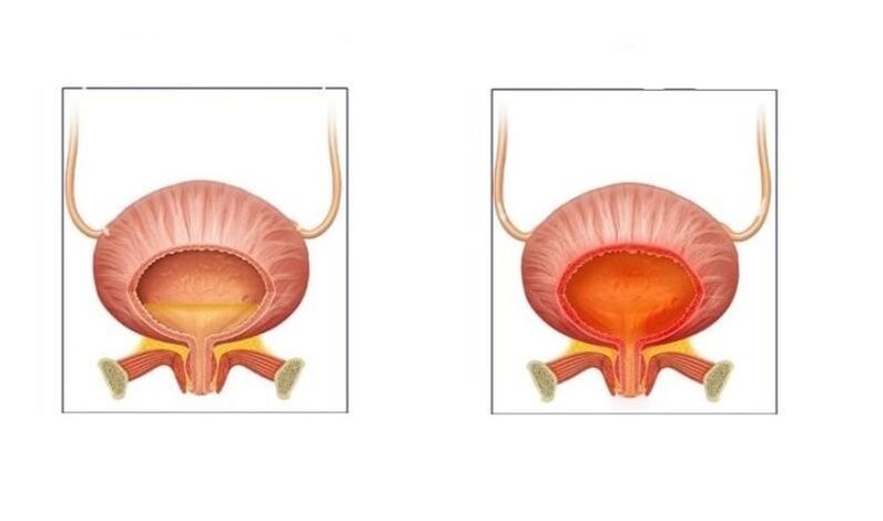 Normálne a pacienti s cystitídou močových ciest