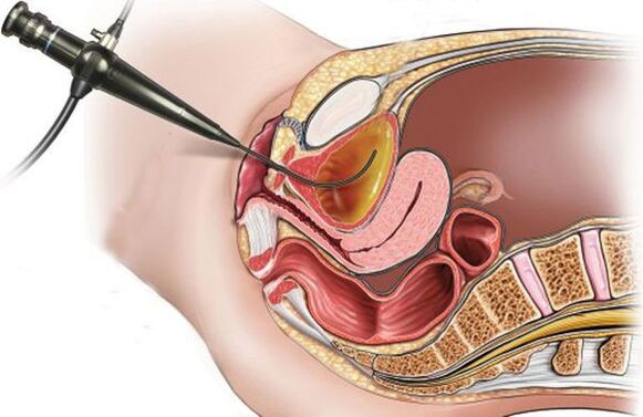 cystoskopia na cystitídu