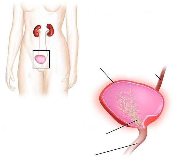 zápal močového mechúra